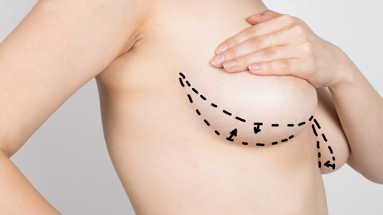 Göğüs Dikleştirme Ameliyatının Uygulama Yöntemleri